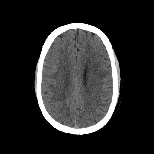CT检查在脑卒中的应用2